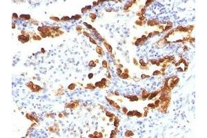 Formalin-fixed, paraffin-embedded human lung carcinoma stained with Cytokeratin 18 antibody (KRT18/835). (Cytokeratin 18 抗体)
