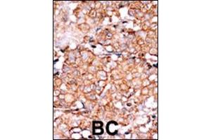 Formalin-fixed and paraffin-embedded human cancer tissue reacted with the primary antibody, which was peroxidase-conjugated to the secondary antibody, followed by AEC staining. (RAD9A 抗体  (pSer328))