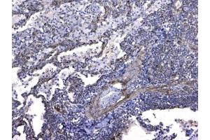 IHC testing of FFPE human lung cancer tissue with GSTM3 antibody at 1ug/ml. (GSTM3 抗体)