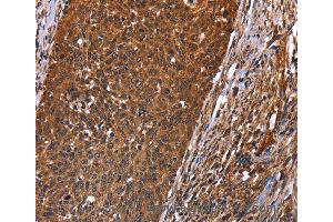 Immunohistochemistry of Human colon cancer using GUK1 Polyclonal Antibody at dilution of 1:40 (GUK1 抗体)