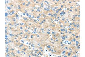 The image on the left is immunohistochemistry of paraffin-embedded Human liver cancer tissue using ABIN7189804(ANGPTL5 Antibody) at dilution 1/25, on the right is treated with synthetic peptide. (ANGPTL5 抗体)
