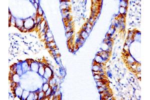Paraformaldehyde-fixed, paraffin embedded human colon cancer, Antigen retrieval by boiling in sodium citrate buffer (pH6. (beta Catenin 抗体  (pSer33))