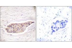 Immunohistochemistry analysis of paraffin-embedded human breast carcinoma tissue, using Annexin A6 Antibody. (ANXA6 抗体  (AA 1-50))