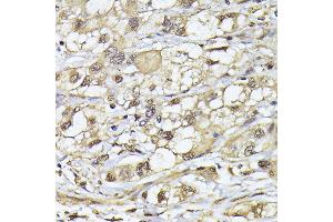 Immunohistochemistry of paraffin-embedded human liver cancer using PSMB3 antibody (ABIN6131929, ABIN6146317, ABIN6146318 and ABIN6225280) at dilution of 1:100 (40x lens). (PSMB3 抗体  (AA 1-205))