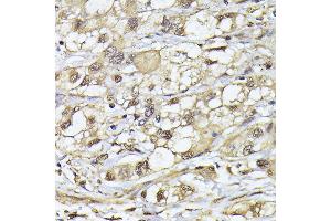 Immunohistochemistry of paraffin-embedded human liver cancer using PSMB3 antibody (ABIN6131929, ABIN6146317, ABIN6146318 and ABIN6225280) at dilution of 1:100 (40x lens). (PSMB3 抗体  (AA 1-205))