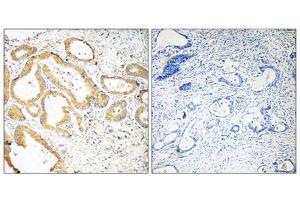 Immunohistochemistry analysis of paraffin-embedded human colon carcinoma tissue using SEPT6 antibody. (Septin 6 抗体  (Internal Region))
