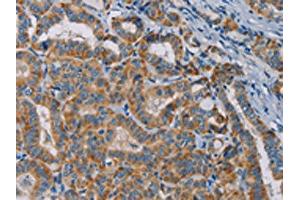 The image is immunohistochemistry of paraffin-embedded Human thyroid cancer tissue using ABIN7131284(TAB3 Antibody) at dilution 1/25. (TAB3 抗体)