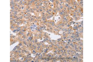 Immunohistochemistry of Human lung cancer using PPP1CB Polyclonal Antibody at dilution of 1:40 (PPP1CB 抗体)