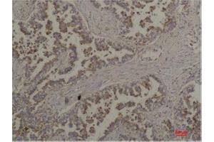 Immunohistochemistry (IHC) analysis of paraffin-embedded Human Lung Carcinoma using Flotillin-2 Rabbit Polyclonal Antibody diluted at 1:200. (Flotillin 2 抗体)