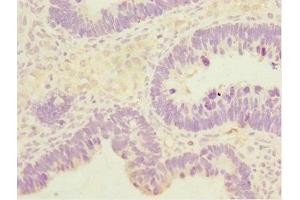 Immunohistochemistry of paraffin-embedded human ovarian cancer using ABIN7171132 at dilution of 1:100 (SYCE1 抗体  (AA 132-351))