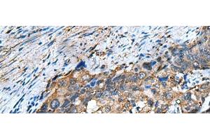 Immunohistochemistry of paraffin-embedded Human cervical cancer tissue using COMMD9 Polyclonal Antibody at dilution of 1:60(x200) (COMMD9 抗体)