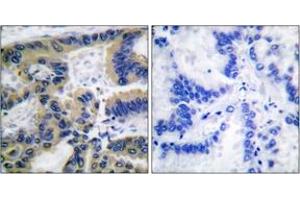 Immunohistochemistry analysis of paraffin-embedded human lung carcinoma tissue, using Caspase 7 (Cleaved-Asp198) Antibody. (Caspase 7 抗体  (Cleaved-Asp198))