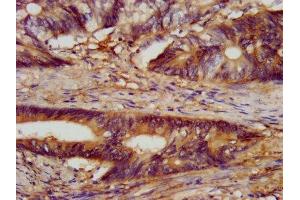 IHC image of ABIN7147493 diluted at 1:300 and staining in paraffin-embedded human colon cancer performed on a Leica BondTM system. (CLN5 抗体  (AA 42-181))