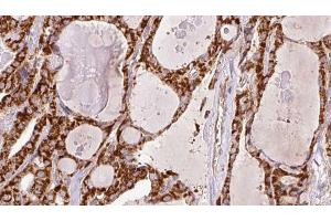 ABIN6266446 at 1/100 staining Human thyroid cancer tissue by IHC-P. (CD28 抗体  (C-Term))