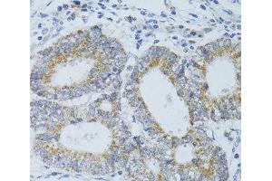 Immunohistochemistry of paraffin-embedded Human colon carcinoma using DNAJC19 Polyclonal Antibody at dilution of 1:100 (40x lens). (DNAJC19 抗体)