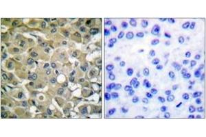 Immunohistochemistry analysis of paraffin-embedded human breast carcinoma tissue, using Keratin 18 (Ab-33) Antibody. (Cytokeratin 18 抗体  (AA 1-50))