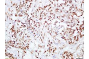 Formalin-fixed and paraffin embedded human lung carcinoma labeled with Rabbit Anti-PI3 Kinase p110 beta(Ser1070) Polyclonal Antibody, Unconjugated  at 1:200 followed by conjugation to the secondary antibody and DAB staining (PIK3CB 抗体  (pSer1070))