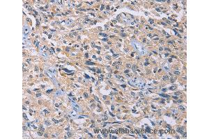Immunohistochemistry of Human esophagus cancer using GNB5 Polyclonal Antibody at dilution of 1:20 (GNB5 抗体)