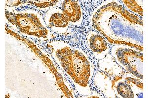 ABIN6257299 and ABIN6275373 at 1/100 staining Human ovarian cancer by IHC-P. (KCNK17 抗体)