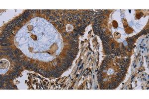 Immunohistochemistry of paraffin-embedded Human colon cancer tissue using FGF18 Polyclonal Antibody at dilution 1:40 (FGF18 抗体)