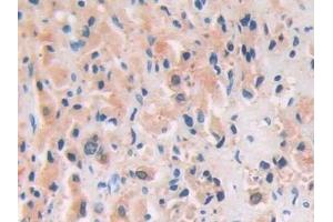 Detection of CAP1 in Human Prostate cancer Tissue using Polyclonal Antibody to Channel Activating Protease 1 (CAP1) (PRSS8 抗体  (AA 33-218))