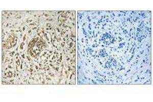 Immunohistochemistry analysis of paraffin-embedded human breast carcinoma tissue, using CIB2 antibody. (CIB2 抗体)