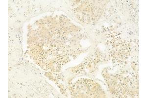 ABIN6262334 and ABIN6279483 at 1/100 staining human prostate carcinoma by IHC-P. (HNRPDL 抗体  (C-Term))