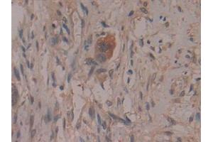 Detection of COX 2 in Human Pancreatic cancer Tissue using Polyclonal Antibody to Cyclooxygenase-2 (COX 2) (COX2 抗体  (AA 187-425))