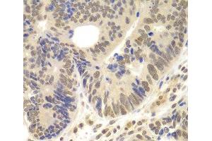 Immunohistochemistry of paraffin-embedded Human colon carcinoma using LHX4 Polyclonal Antibody at dilution of 1:100 (40x lens). (LHX4 抗体)