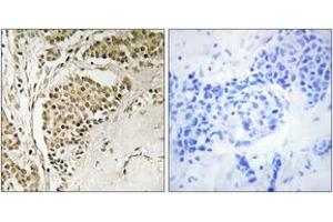 Immunohistochemistry analysis of paraffin-embedded human breast carcinoma tissue, using NOM1 Antibody. (NOM1 抗体  (AA 661-710))