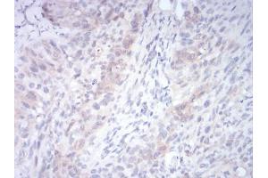Immunohistochemical analysis of paraffin-embedded cervical cancer tissues using RND3 mouse mAb with DAB staining. (RND3 抗体  (AA 104-241))