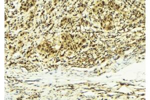 ABIN6279208 at 1/100 staining Human breast cancer tissue by IHC-P. (CABIN1 抗体  (Internal Region))