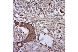 Paraformaldehyde-fixed, paraffin embedded human cervical cancer, Antigen retrieval by boiling in sodium citrate buffer (pH6.