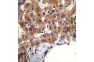 Immunohistochemistry analysis in formalin fixed and paraffin embedded human liver tissue reacted with MBNL2 Antibody (C-term) followed which was peroxidase conjugated to the secondary antibody and followed by AB staining. (MBNL2 抗体  (C-Term))