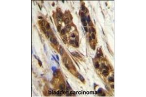 SNR27 Antibody (Center) (ABIN655835 and ABIN2845250) immunohistochemistry analysis in formalin fixed and paraffin embedded human bladder carcinoma followed by peroxidase conjugation of the secondary antibody and DAB staining. (SNRNP27 抗体  (AA 69-98))