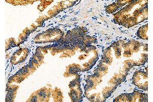 ABIN6263112 and ABIN6266890 at 1/100 staining Human prostate cancer by IHC-P. (MLK4 抗体  (C-Term))