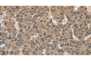 Immunohistochemistry of paraffin-embedded Human liver cancer tissue using DACH2 Polyclonal Antibody at dilution 1:40 (DACH2 抗体)