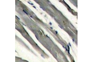 IHC analysis of FFPE human hepatocarcinoma stained with LRRK2 antibody (LRRK2 抗体  (AA 878-909))