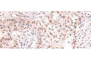 Immunohistochemistry of paraffin-embedded Human esophagus cancer tissue using ZNF559 Polyclonal Antibody at dilution of 1:80(x200) (ZNF559 抗体)