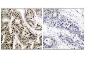 Immunohistochemical analysis of paraffin- embedded human breast carcinoma tissue using NF-κB p105/p50 (phospho-Ser337) antibody (E011017). (NFKB1 抗体  (pSer337))