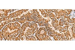 Immunohistochemistry of paraffin-embedded Human thyroid cancer tissue using NPC2 Polyclonal Antibody at dilution of 1:80(x200) (NPC2 抗体)