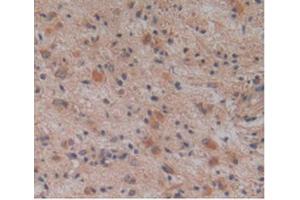 IHC-P analysis of Human Glioma Tissue, with DAB staining. (ALT 抗体  (AA 255-496))