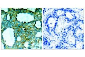 Immunohistochemical analysis of paraffin-embedded human breast carcinoma tissue using PAK1(Phospho-Thr212) Antibody(left) or the same antibody preincubated with blocking peptide(right). (PAK1 抗体  (pThr212))