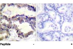 Immunohistochemical analysis of paraffin-embedded human lung carcinoma tissue using CASP2 polyclonal antibody . (Caspase 2 抗体  (Ser140))