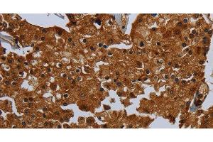 Immunohistochemistry of paraffin-embedded Human prostate cancer tissue using ENTPD7 Polyclonal Antibody at dilution 1:60 (ENTPD7 抗体)