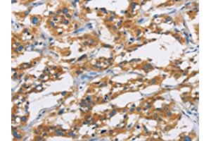 The image is immunohistochemistry of paraffin-embedded Human thyroid cancer tissue using ABIN7130969(SAR1B Antibody) at dilution 1/20. (SAR1B 抗体)