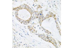 Immunohistochemistry of paraffin-embedded human gastric cancer using IRS1 antibody (ABIN5970075) at dilution of 1/100 (40x lens).