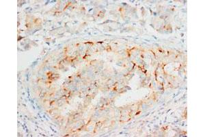 Immunohistochemical staining of OPCML on formalin fixed, paraffin embedded human mammary cancer with OPCML polyclonal antibody . (OPCML 抗体  (C-Term))
