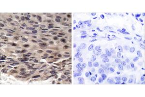 P-Peptide - +Immunohistochemical analysis of paraffin-embedded human breast carcinoma tissue using FKHRL1 (phospho-Ser253) antibody. (eIF4EBP1 抗体  (pThr36))