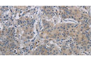 Immunohistochemistry of paraffin-embedded Human gastric cancer using DNAJB4 Polyclonal Antibody at dilution of 1:50 (DNAJB4 抗体)